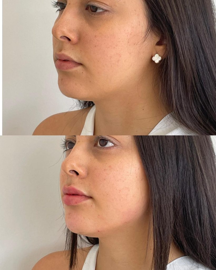 Resultado de contorno facial e qualidade da pele