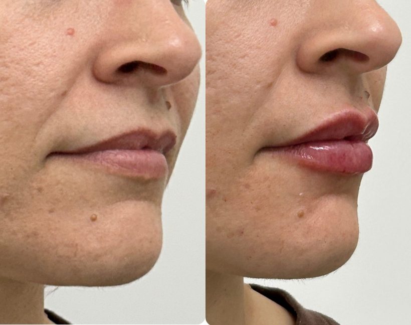 Resultado de preenchimento labial